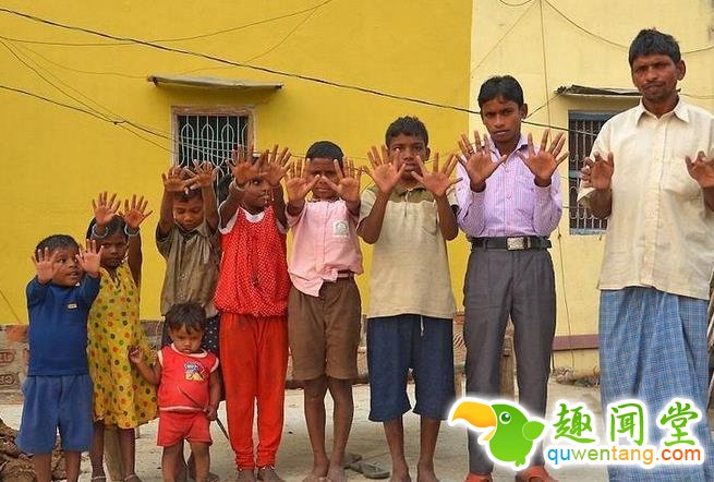 印度神奇家族每人有12个手指和12个脚趾