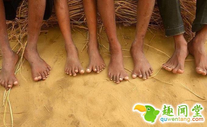 印度神奇家族每人有12个手指和12个脚趾